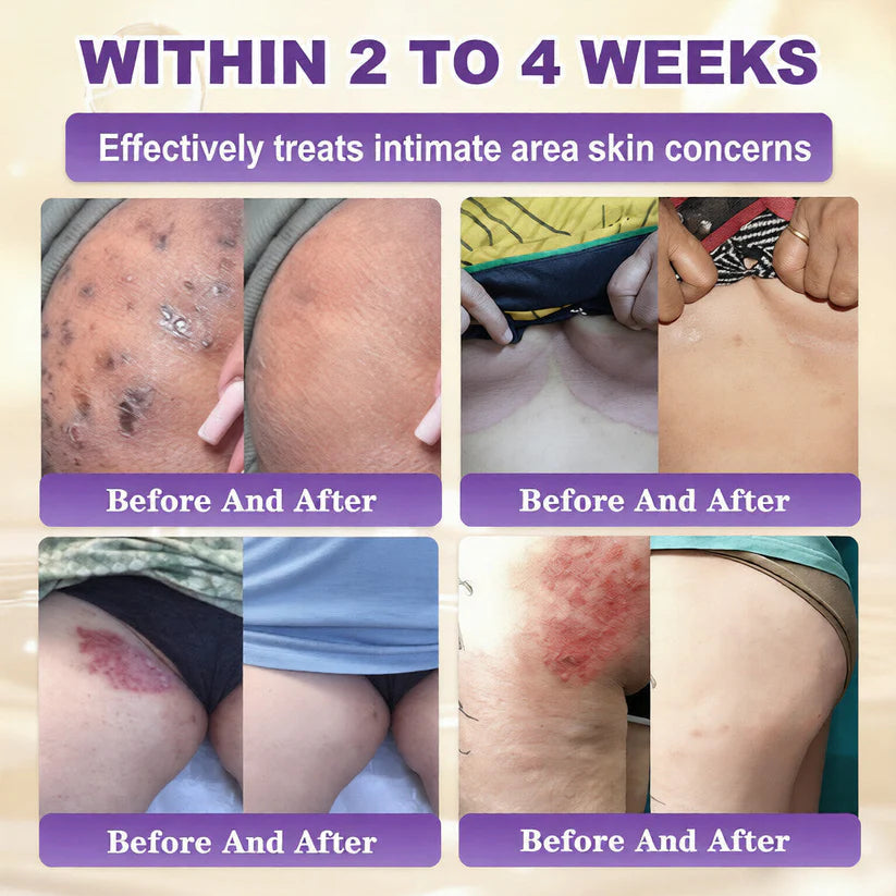 Ivopalo® Advanced Silicone Scar Gel – Professional Scar Removal Cream for Surgical Scars, Keloids, Stretch Marks, C-Section & Old or New Scars Repair Treatment