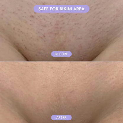 🆙✨2-in-1 Painless Bikini Hair Trimmer for Face & Body