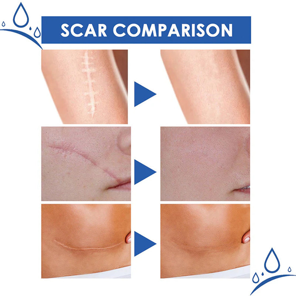 🫧ivopalo® Advanced Scar Repair Cream – Fade Scars & Smooth Skin for All Skin Types